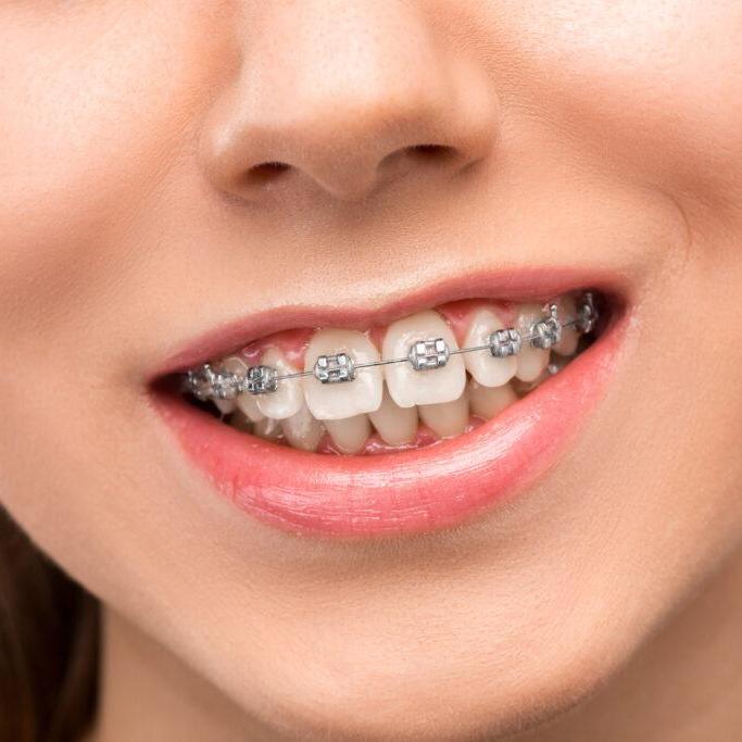 braces  singapore